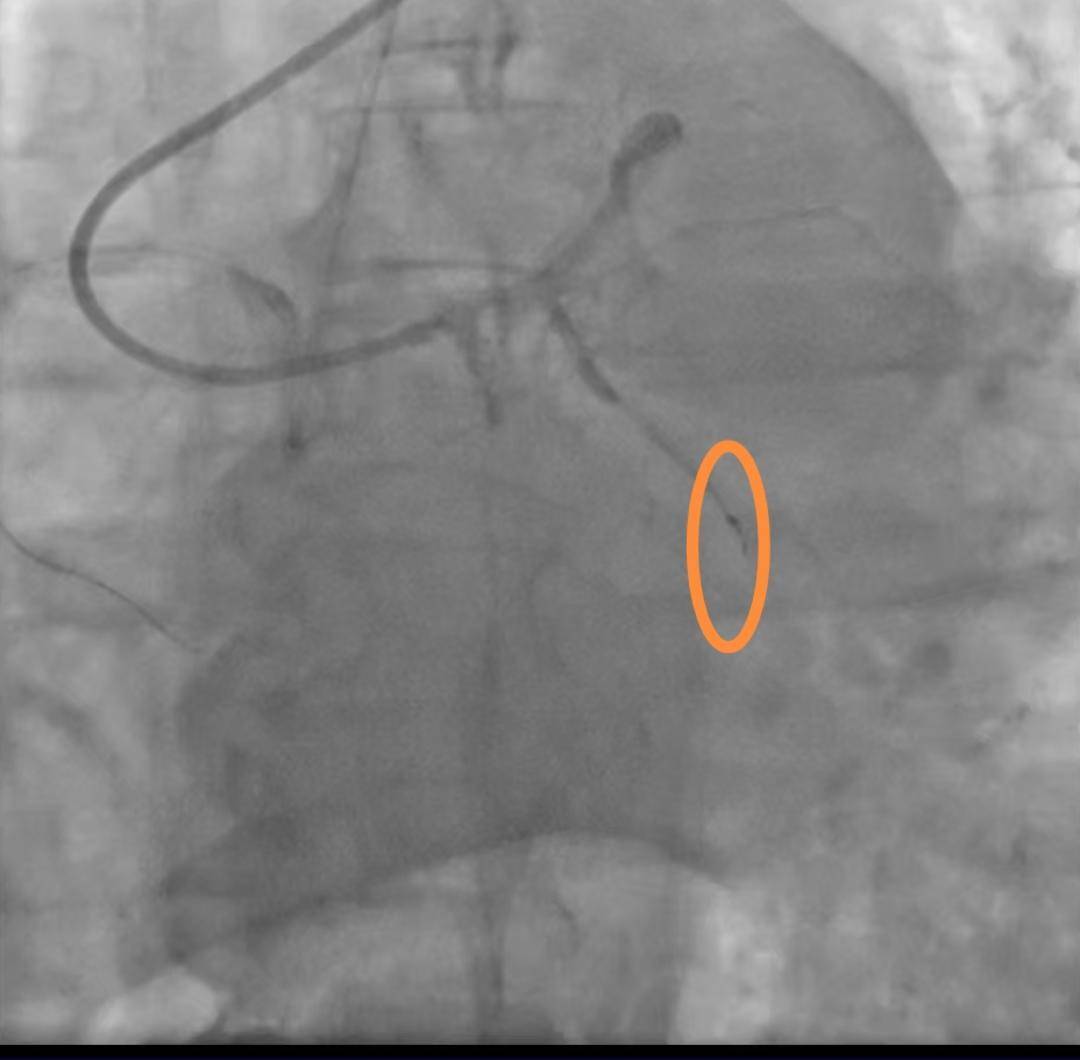 老人手术时导丝断裂掉进血管 医院:外科取出意义不大,补偿8000元